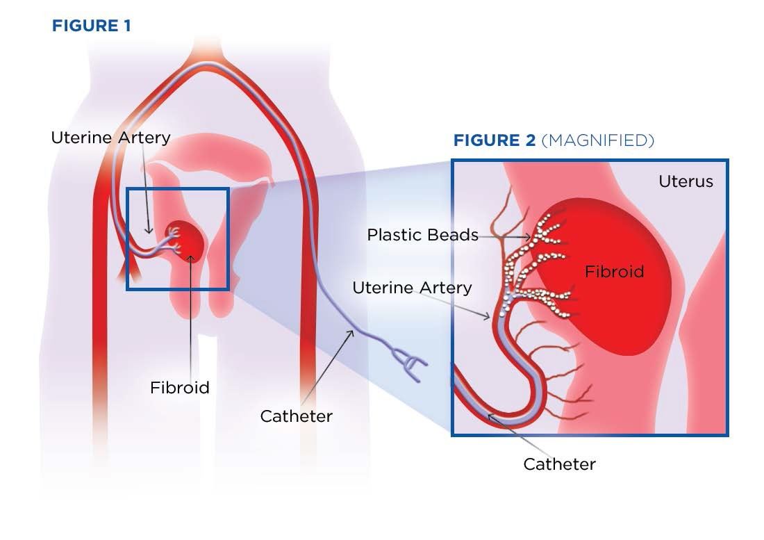 uterine fibroid embolization illustration